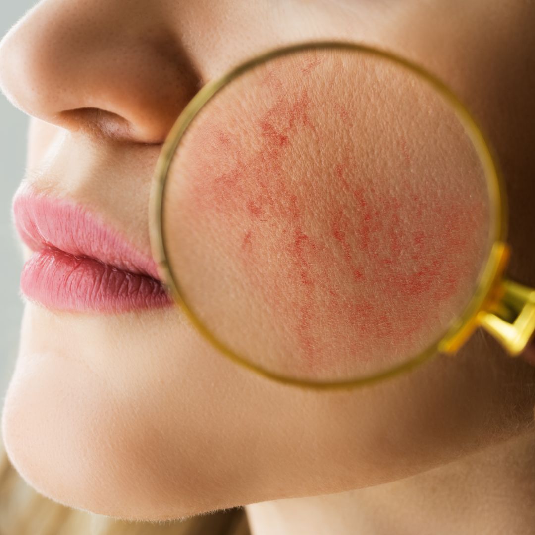 Facial Skin Redness Causes Symptoms And Effective Solutions For Sen Kadee Botanicals