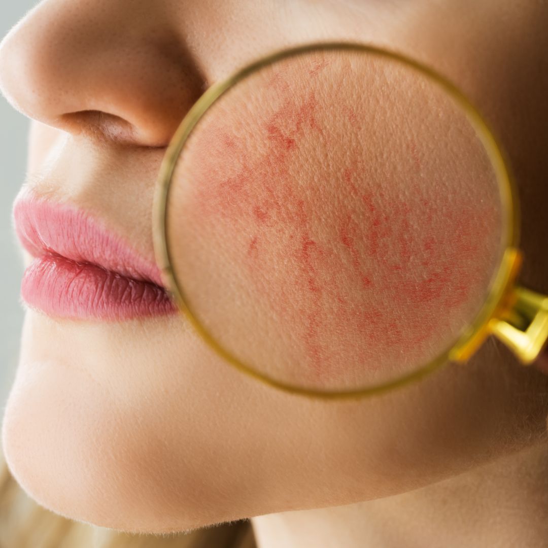 Reactive Redness Facial Skin Redness: Causes, Symptoms, and Effective Solutions for Sen ...